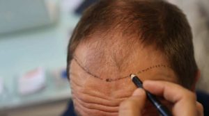 زراعة الشعر في إسطنبول