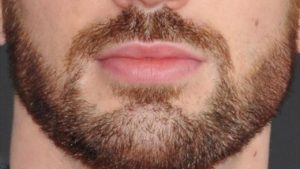 زراعة اللحية