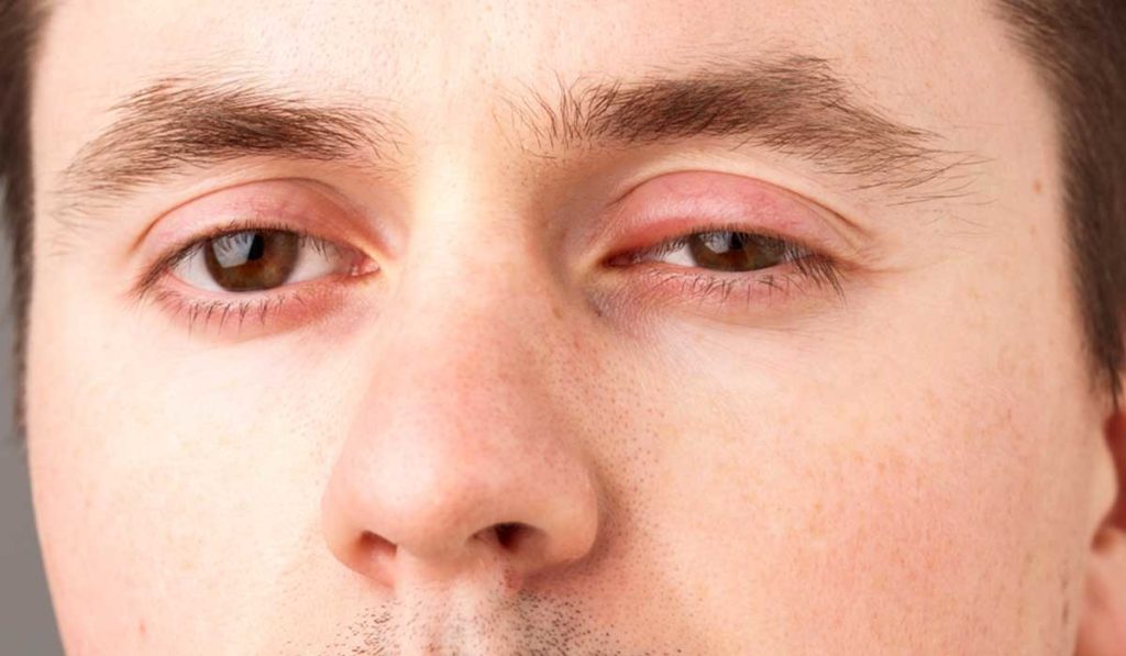 عملية الجفن