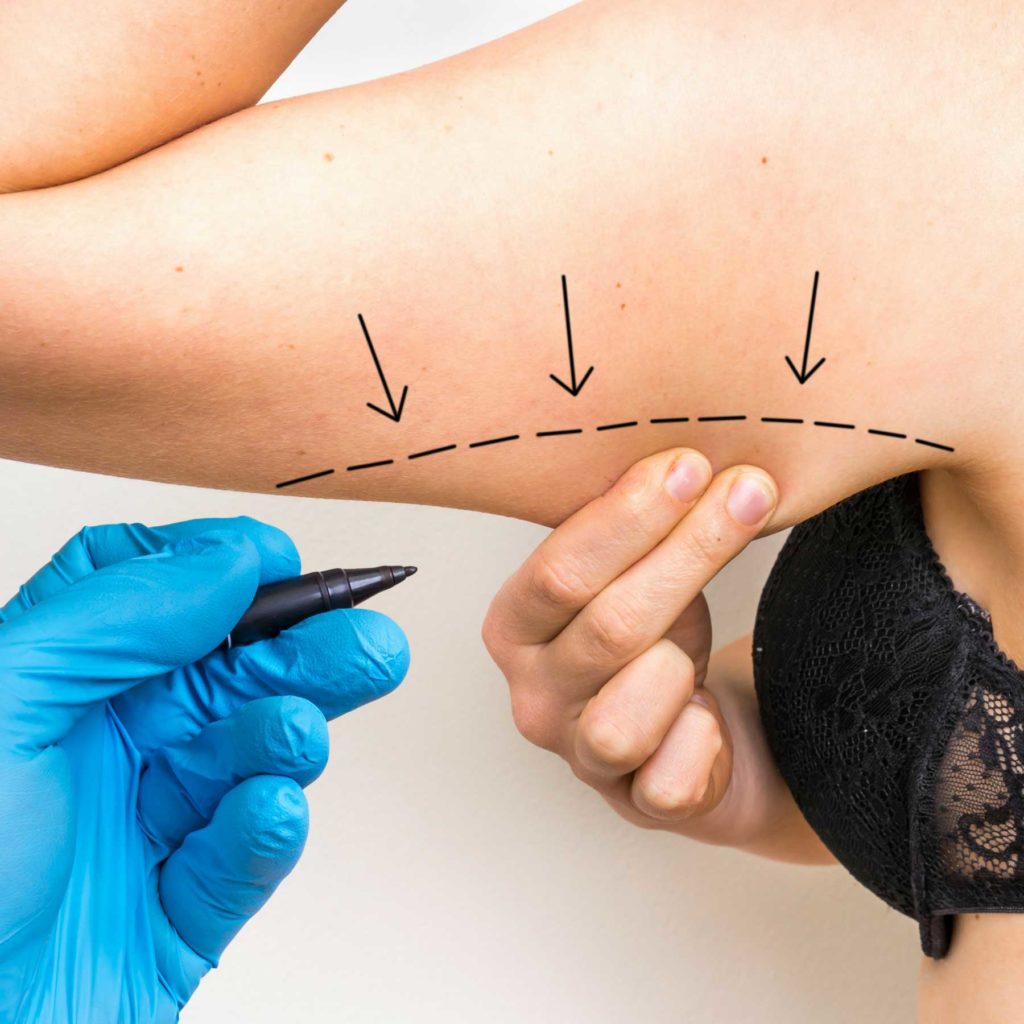 عملية شد الذراع