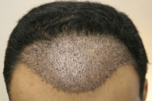 تكلفة زراعة الشعر في طرابزون