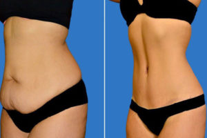 شفط الدهون بالفيزر