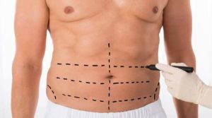 عملية شد البطن في إسطنبول