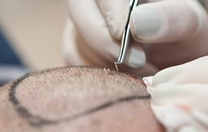 زراعة الشعر بالاقتطاف FUE في تركيا