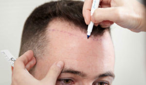 زراعة الشعر بتقنية BHT 