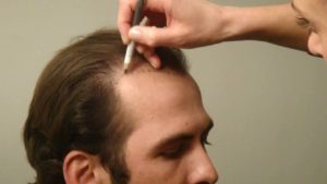 زراعة الشعر بطريقة FUE