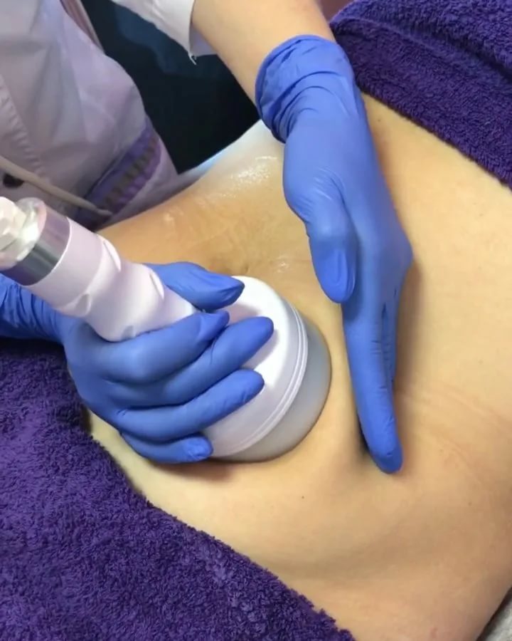  إزالة الكرش