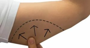 تخسيس الذراعين