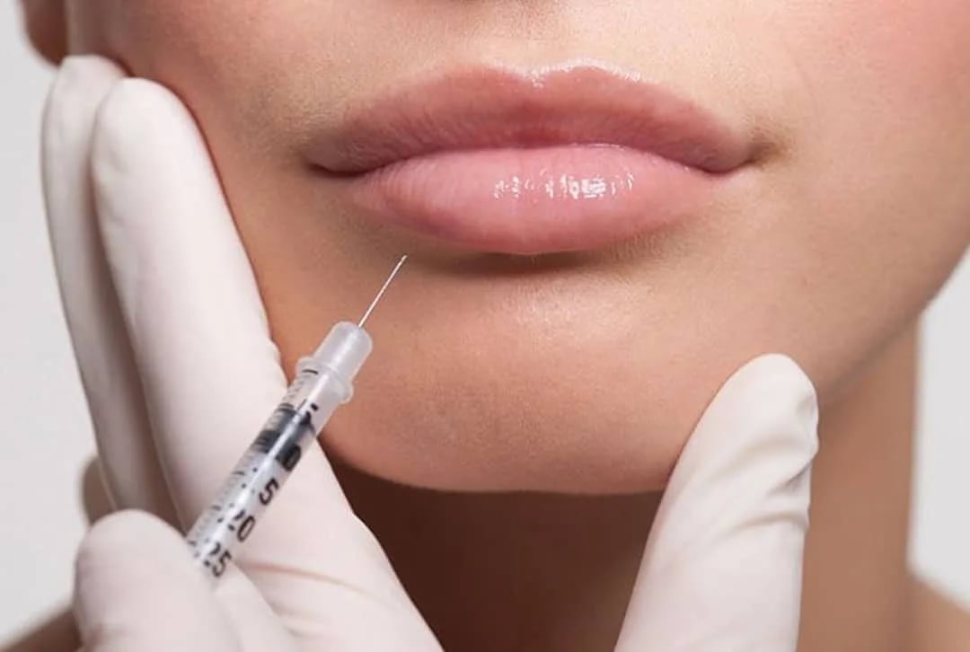 فيلر الشفايف