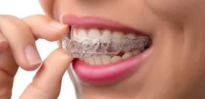 دعامات الأسنان