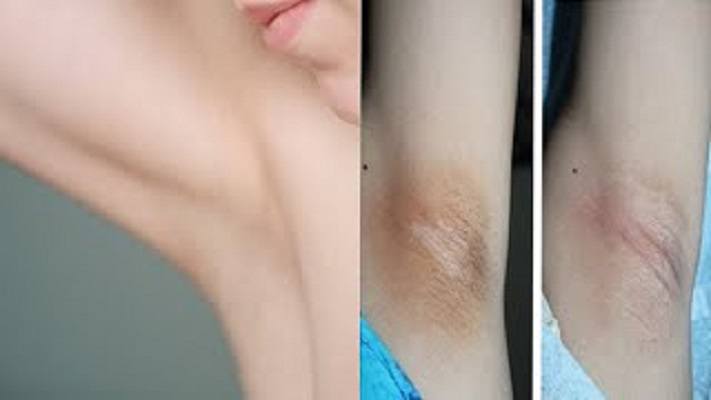 تبييض الإبط 