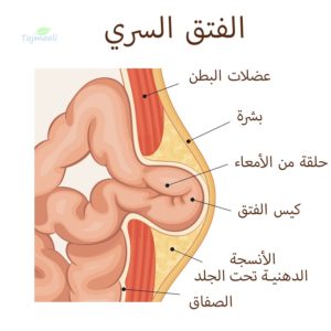 عملية الفتاق