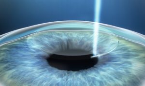 عملية الفيمتو سمايل