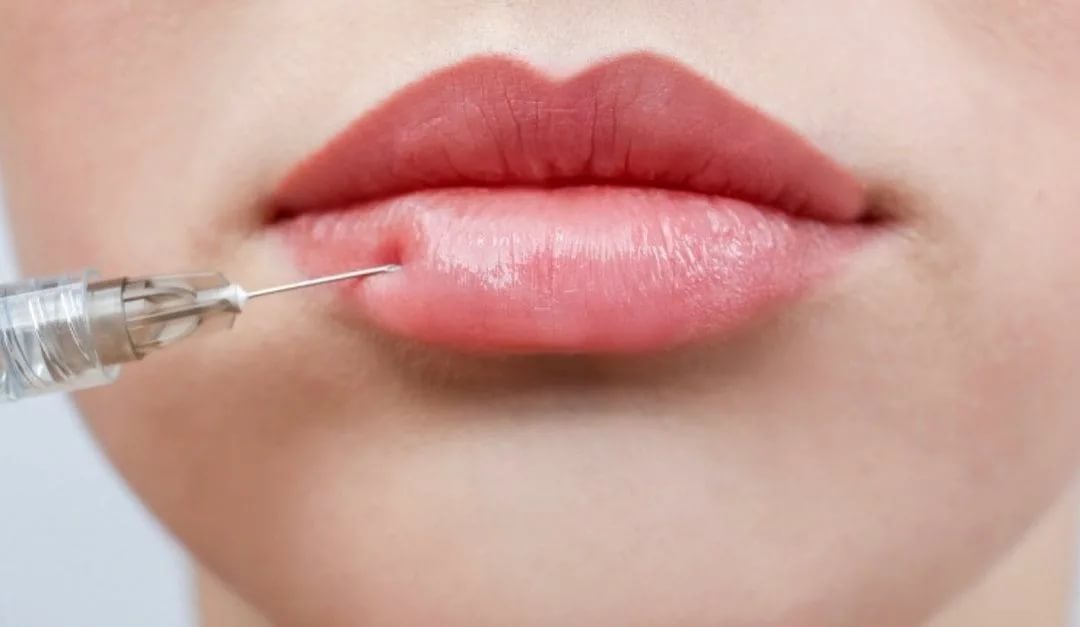 فيلر الشفايف