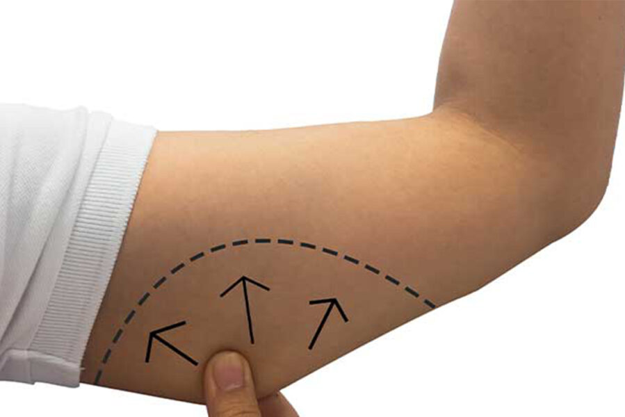 شد ترهلات الذراع