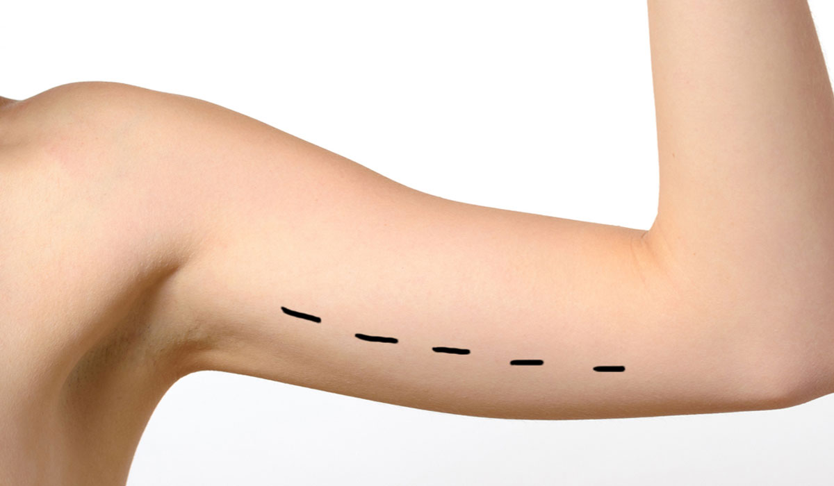 شد ترهلات الذراع