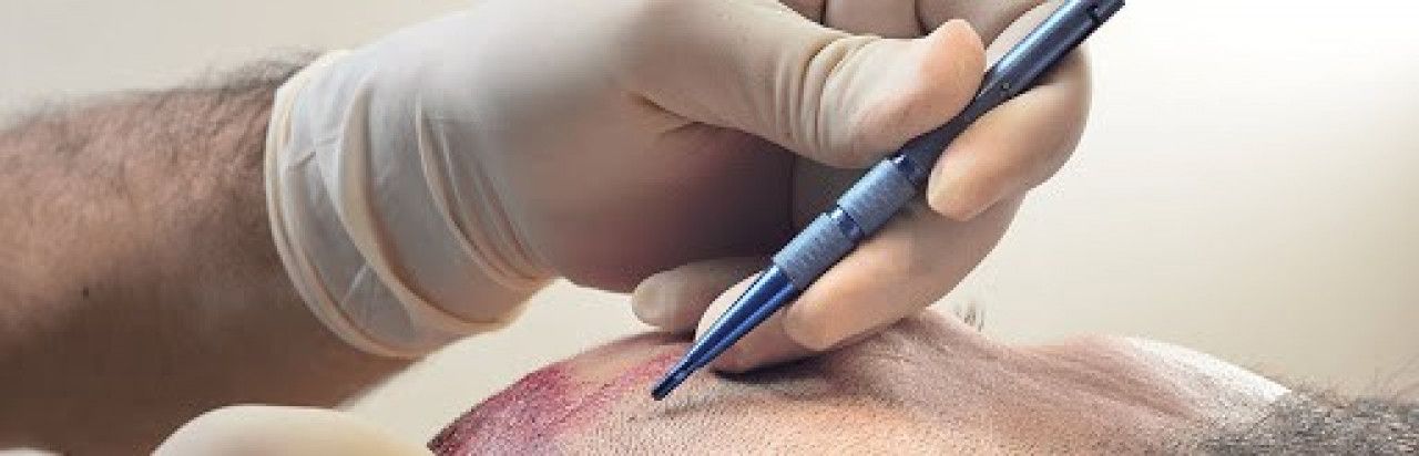 زراعة الشعر بتقنية السفير