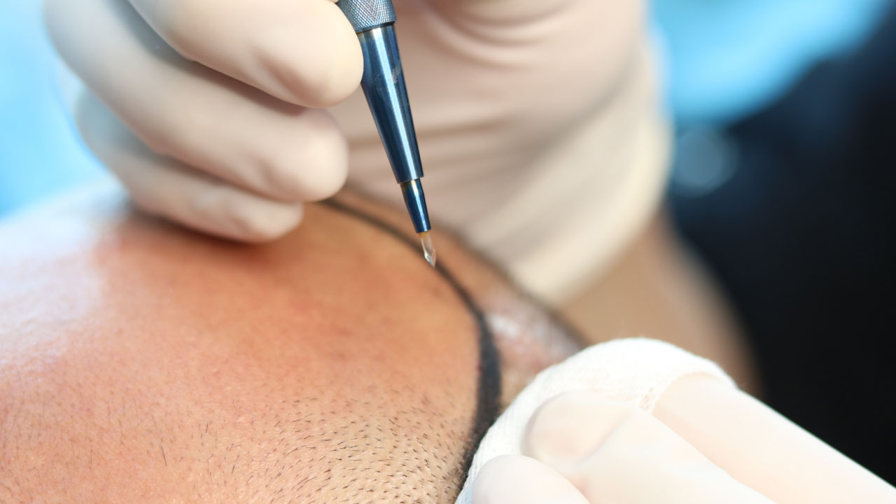 زراعة الشعر بتقنية السفير