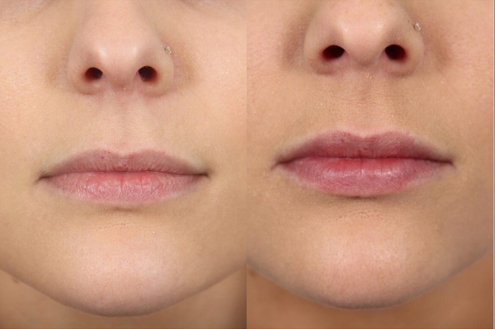 عمليات تجميل الشفاه