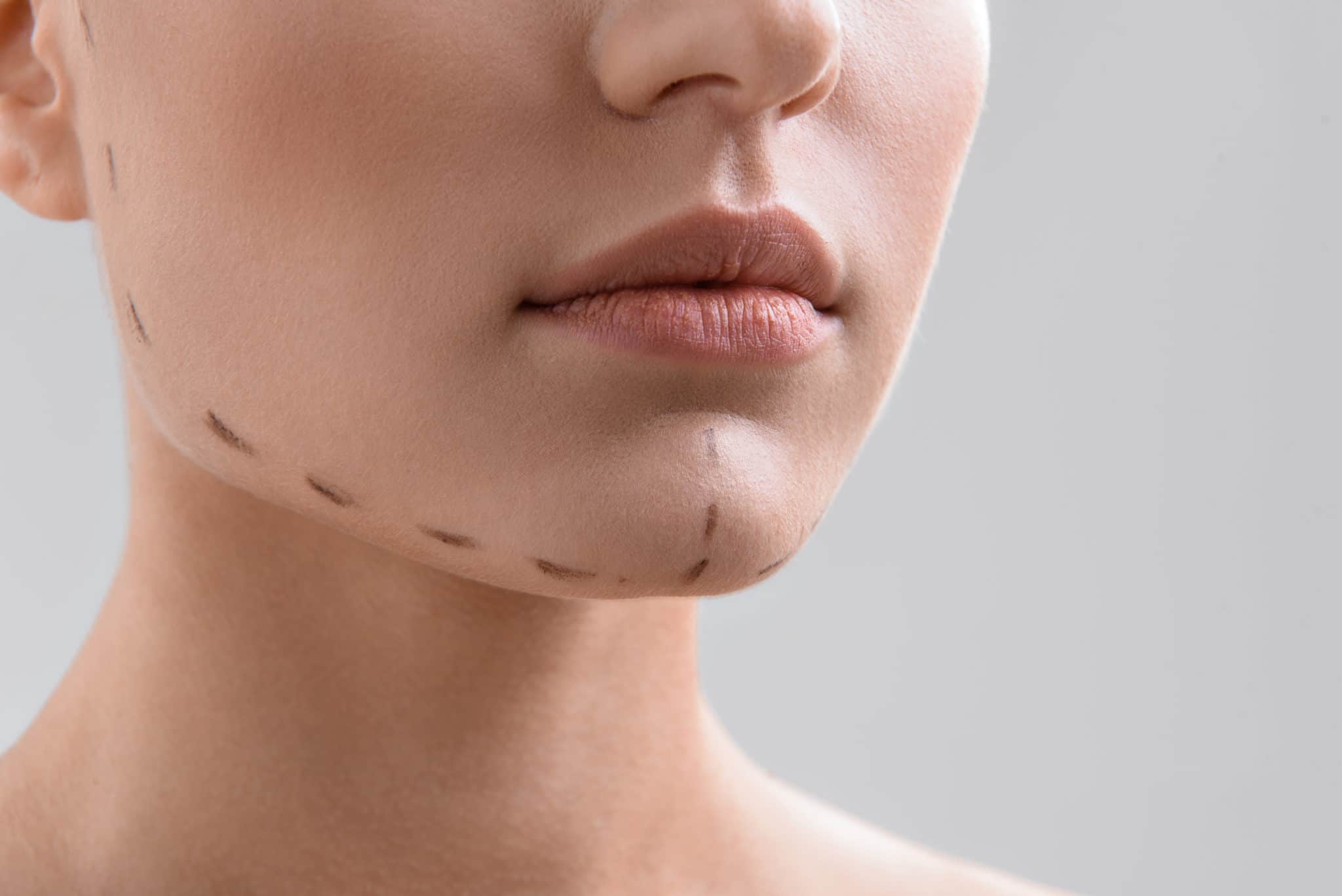 تجميل الفك السفلي