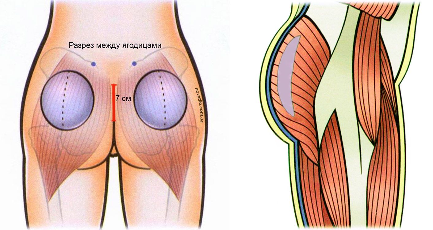 عمليات تجميل الأرداف