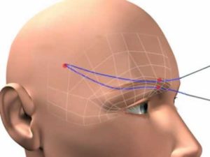 رفع الحواجب بالخيوط