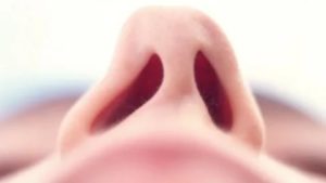 علاج انحراف الأنف