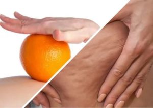 التخلص من السيلوليت