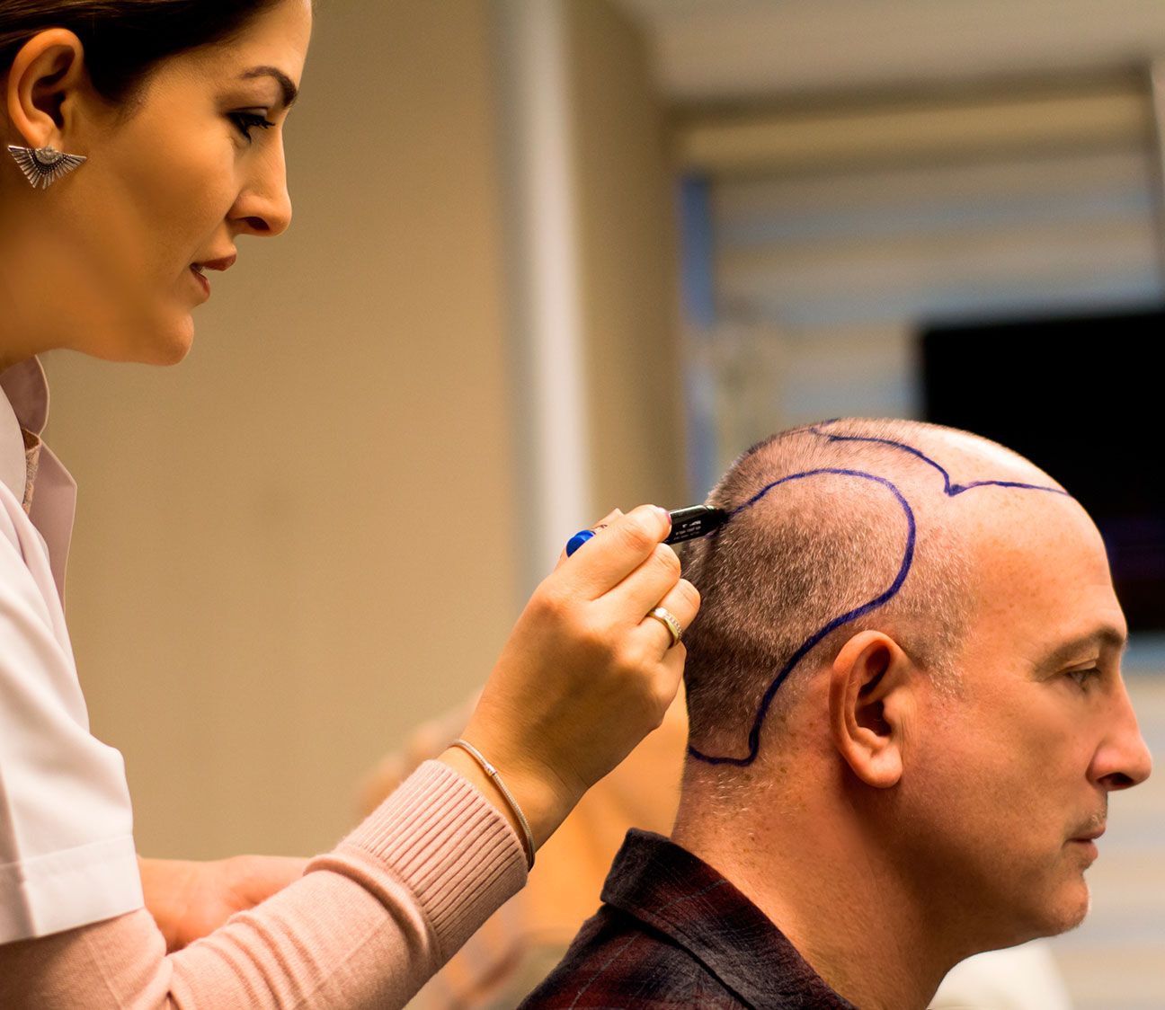 Центр пересадки волос. Татуаж на голове для мужчин. Трансплантация волос с затылка.