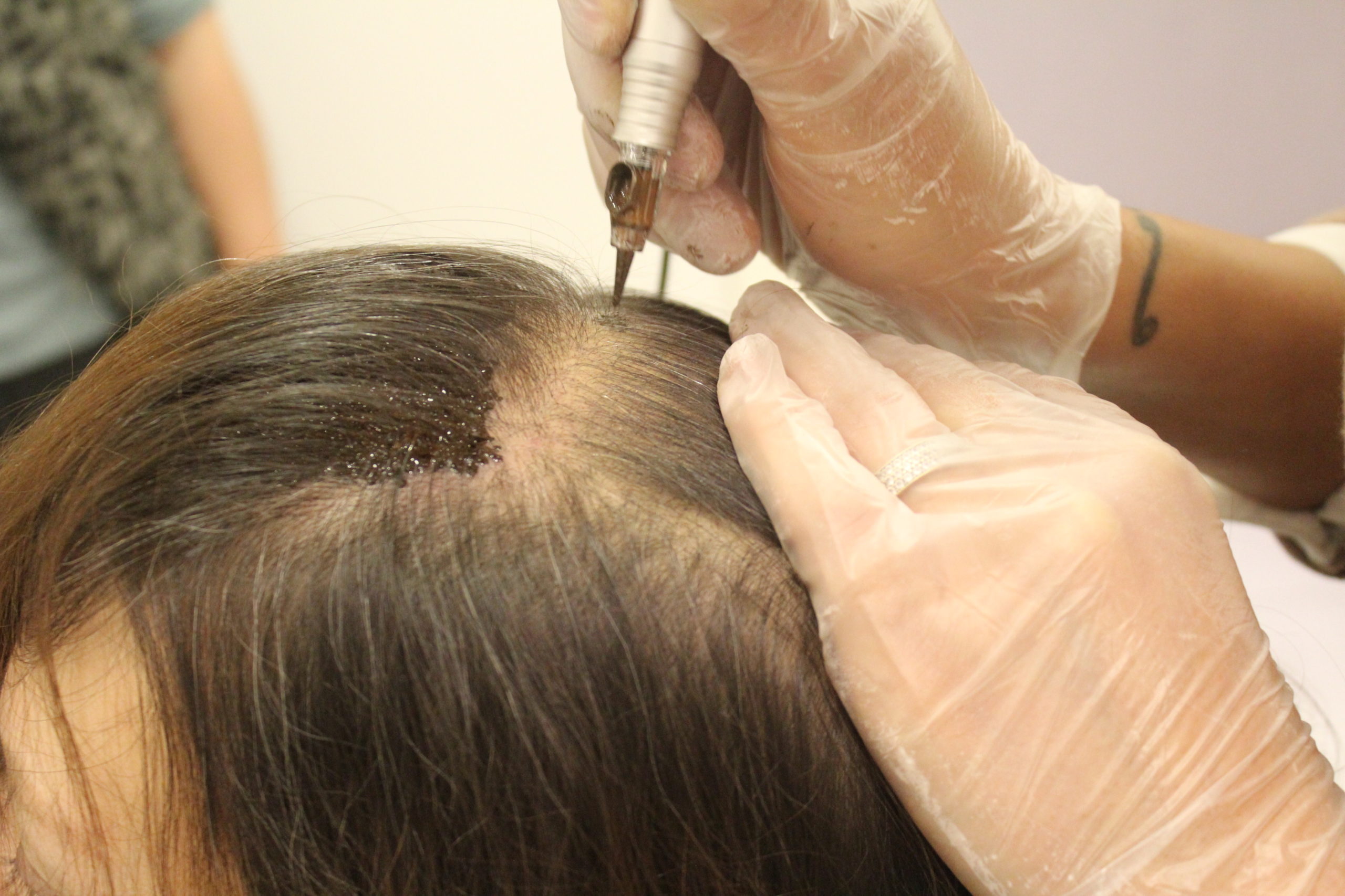 زراعة الشعر في تركيا للنساء