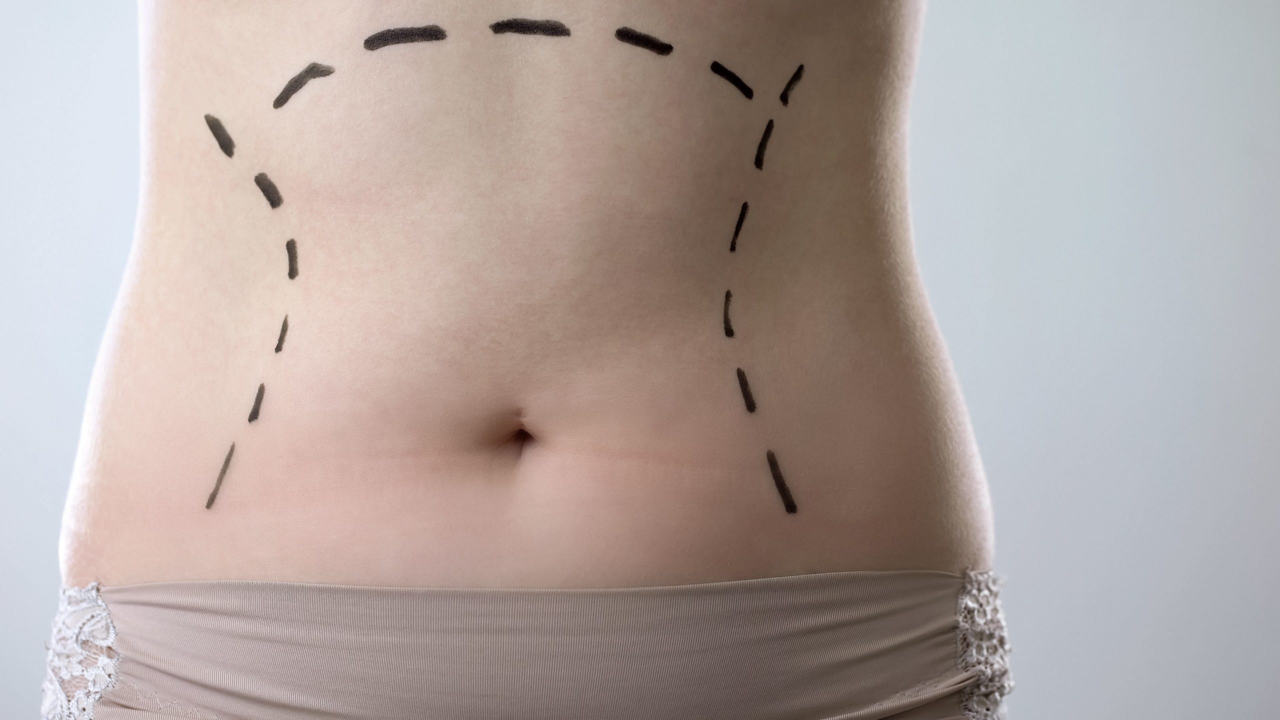 نحت الجسم بالليزر