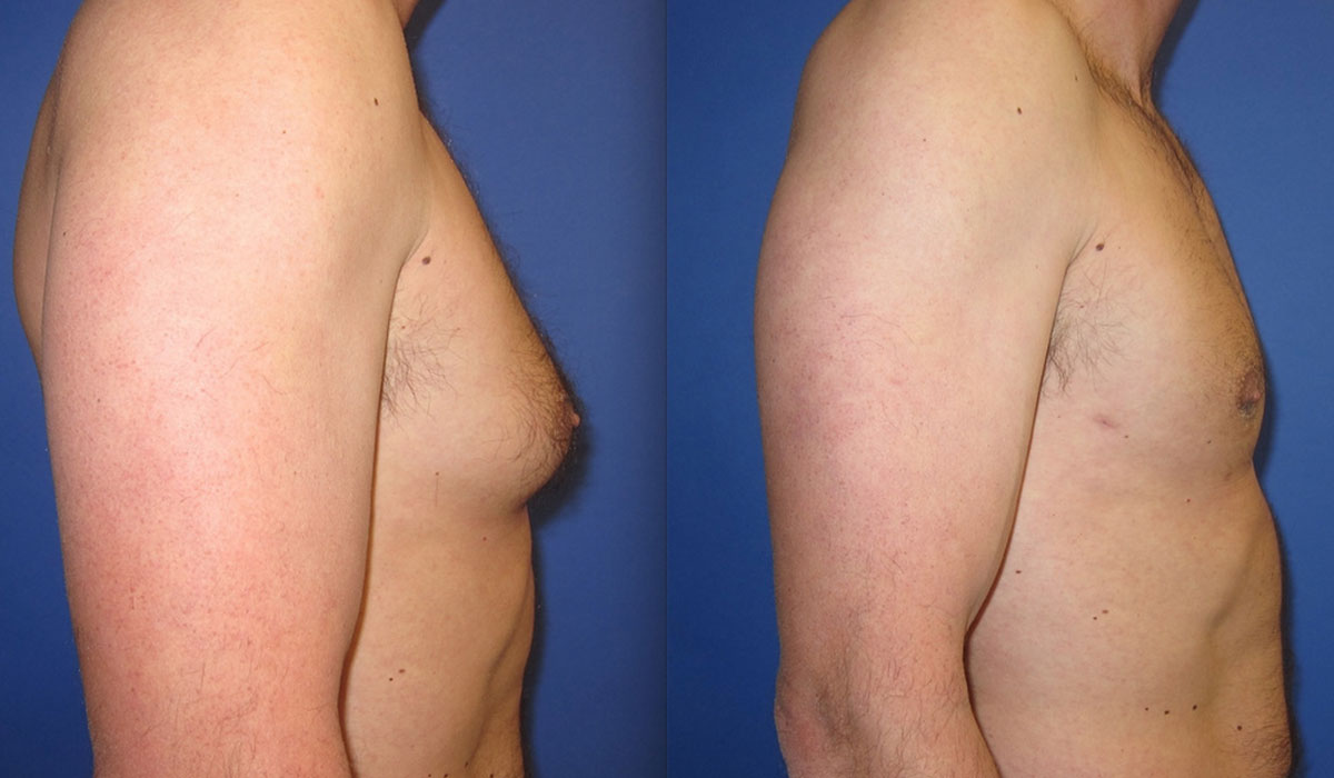 التثدي عند الرجال