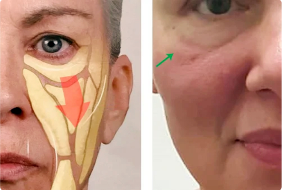 حشوات السيلكون