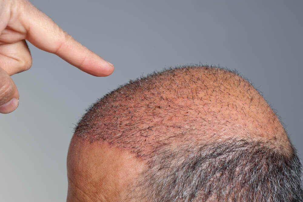 زراعة الشعر بتقنية الاقتطاف