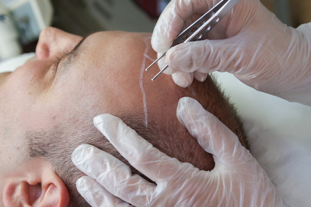 زراعة الشعر بتقنية الاقتطاف