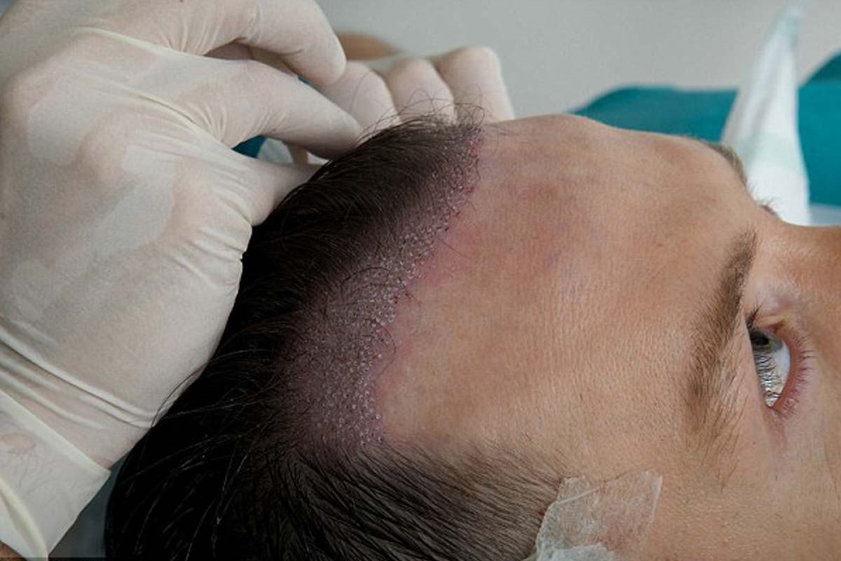 عملية زراعة الشعر في تركيا