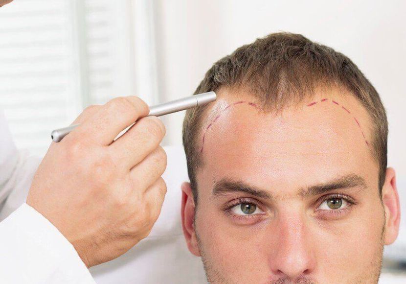 زراعة الشعر لمرضى السكر