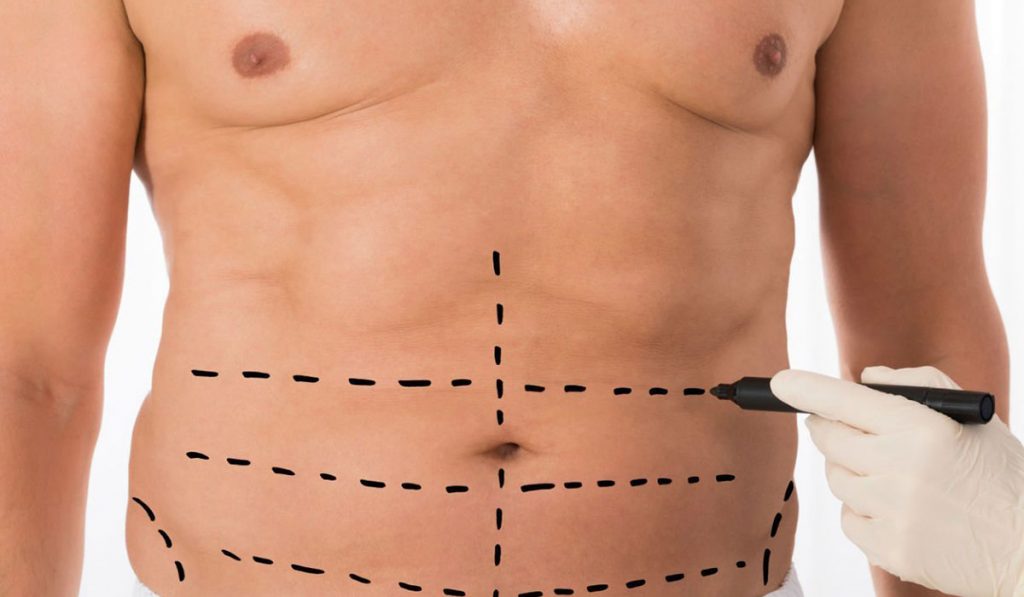 نحت الجسم بالفيزر