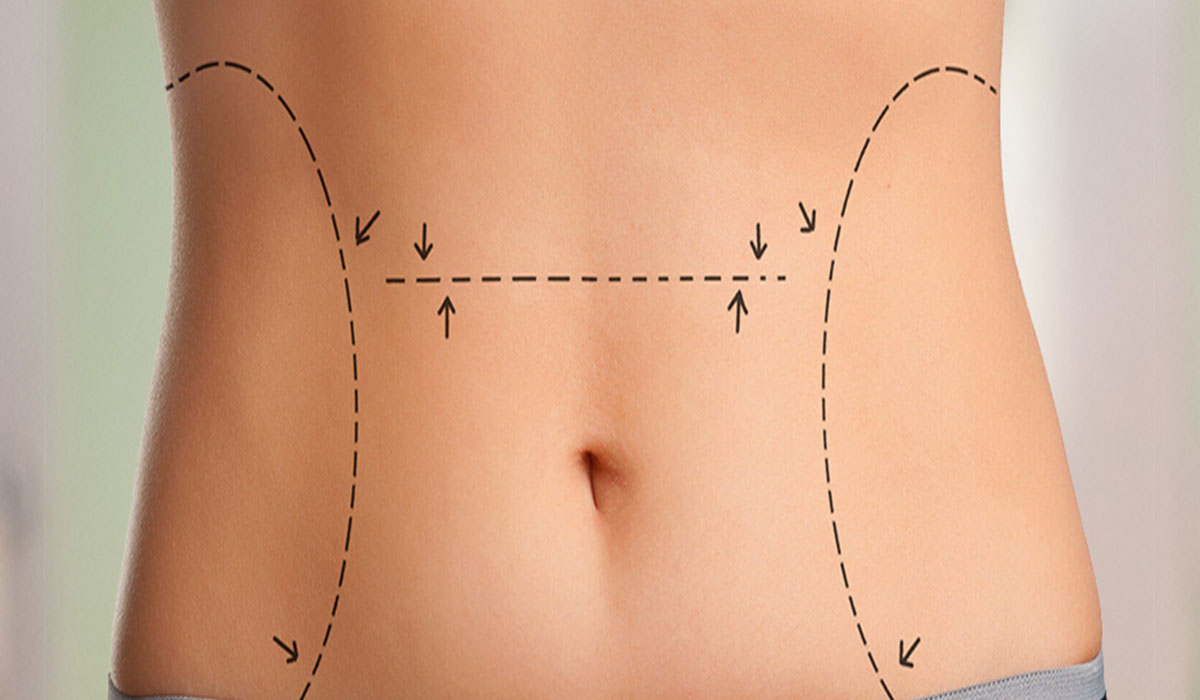 نحت الجسم بالفيزر