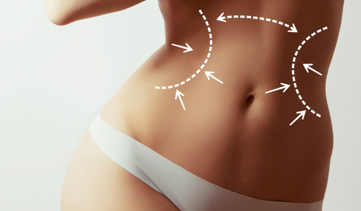 نحت الجسم بالليزر