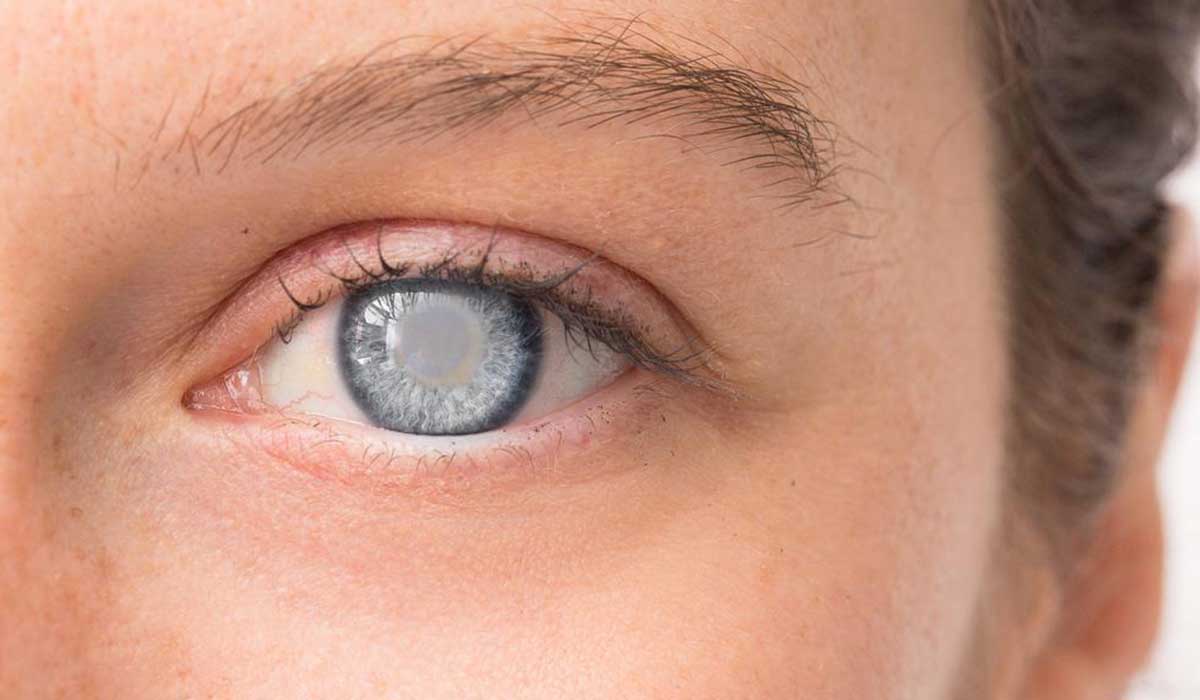 ازالة المياه البيضاء في تركيا