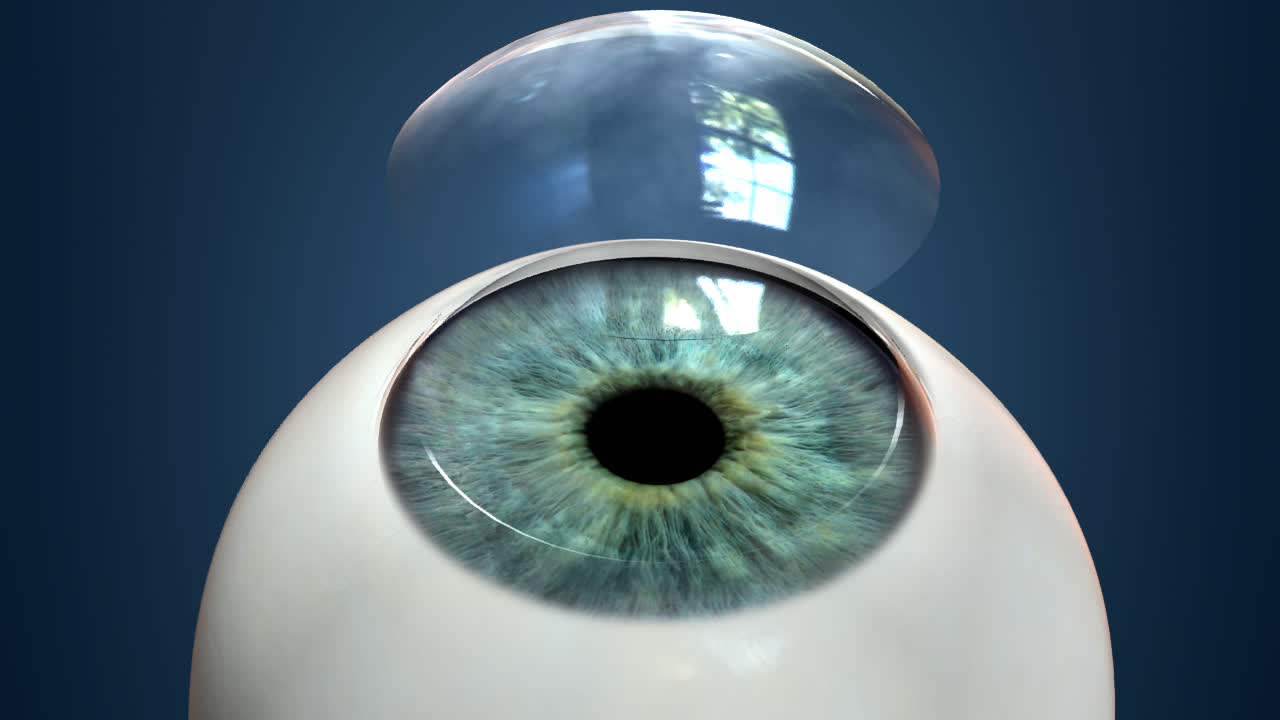 زراعة القرنية في تركيا