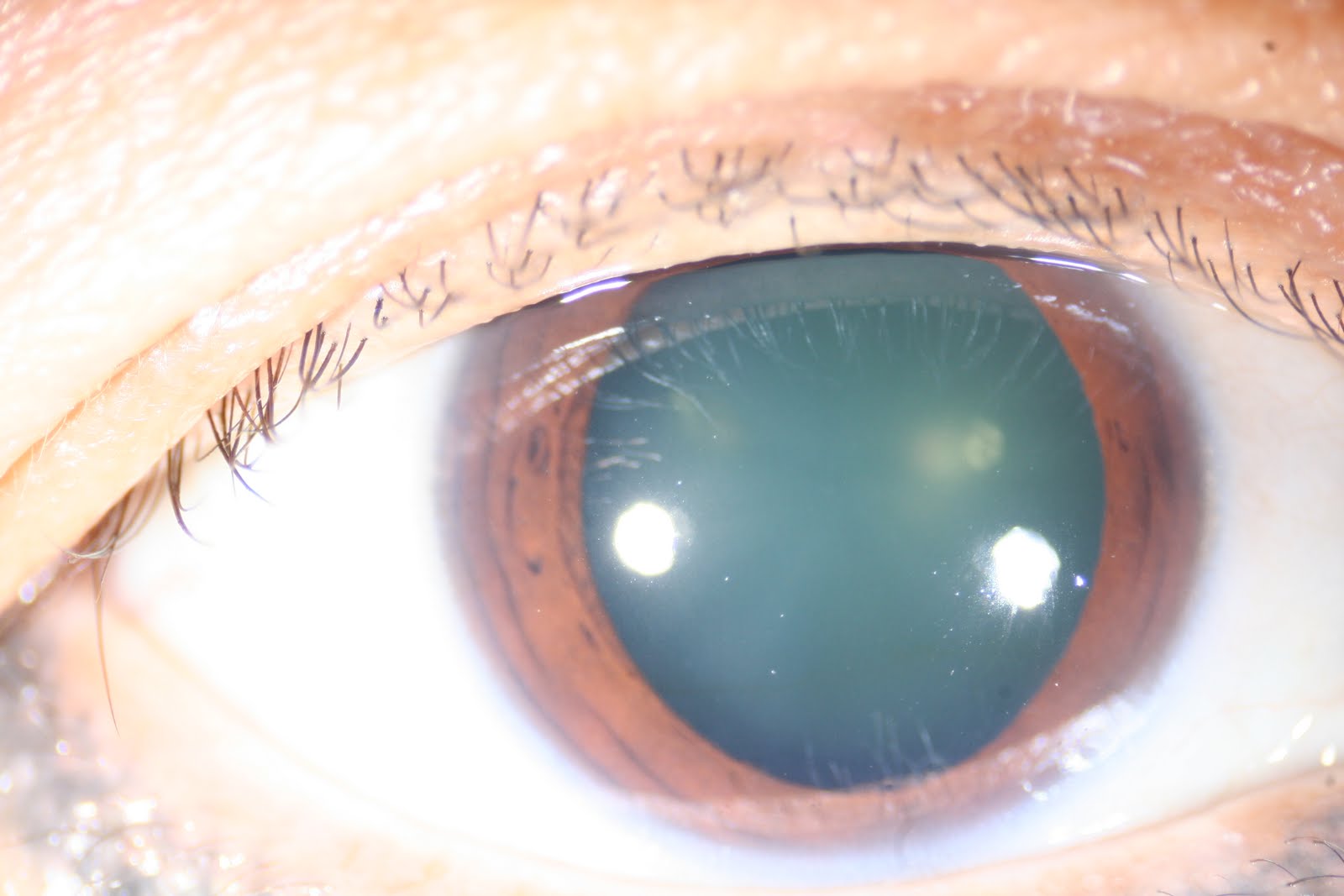 ازالة المياه البيضاء في تركيا