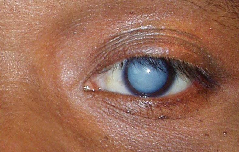 ازالة المياه البيضاء في تركيا