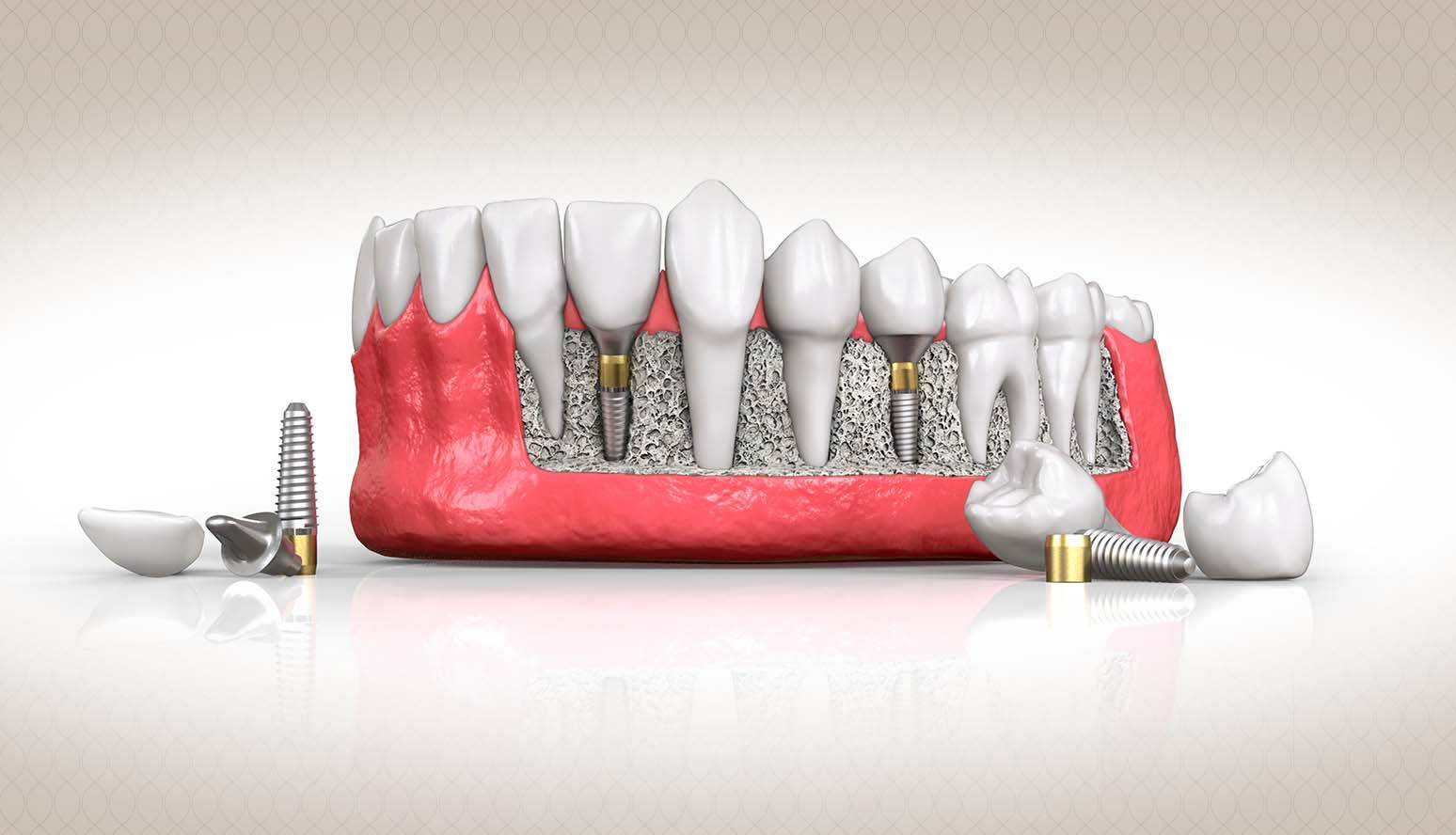 أفضل مستشفى زراعة الأسنان في تركيا