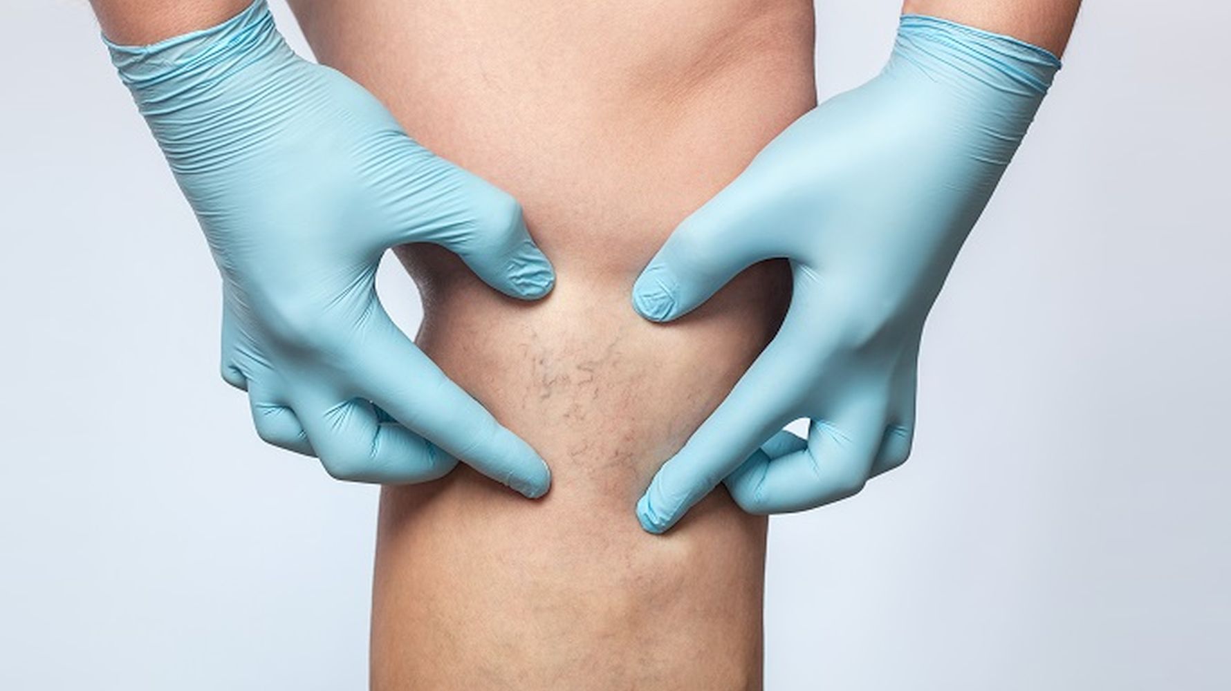 علاج الدوالي بالليزر في تركيا