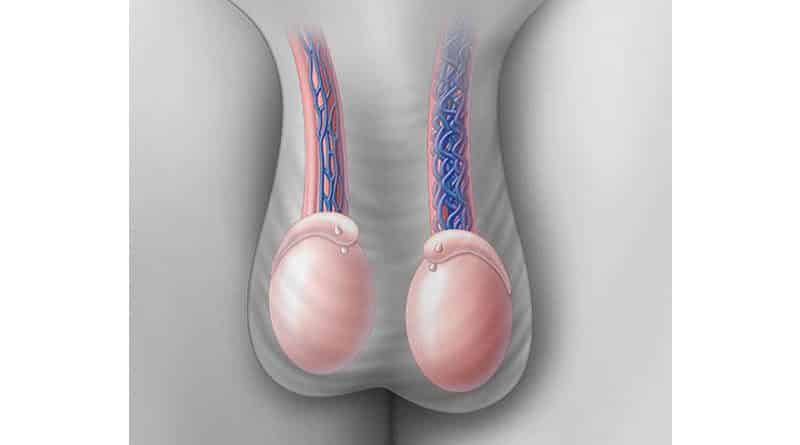 عملية دوالي الخصية في تركيا 