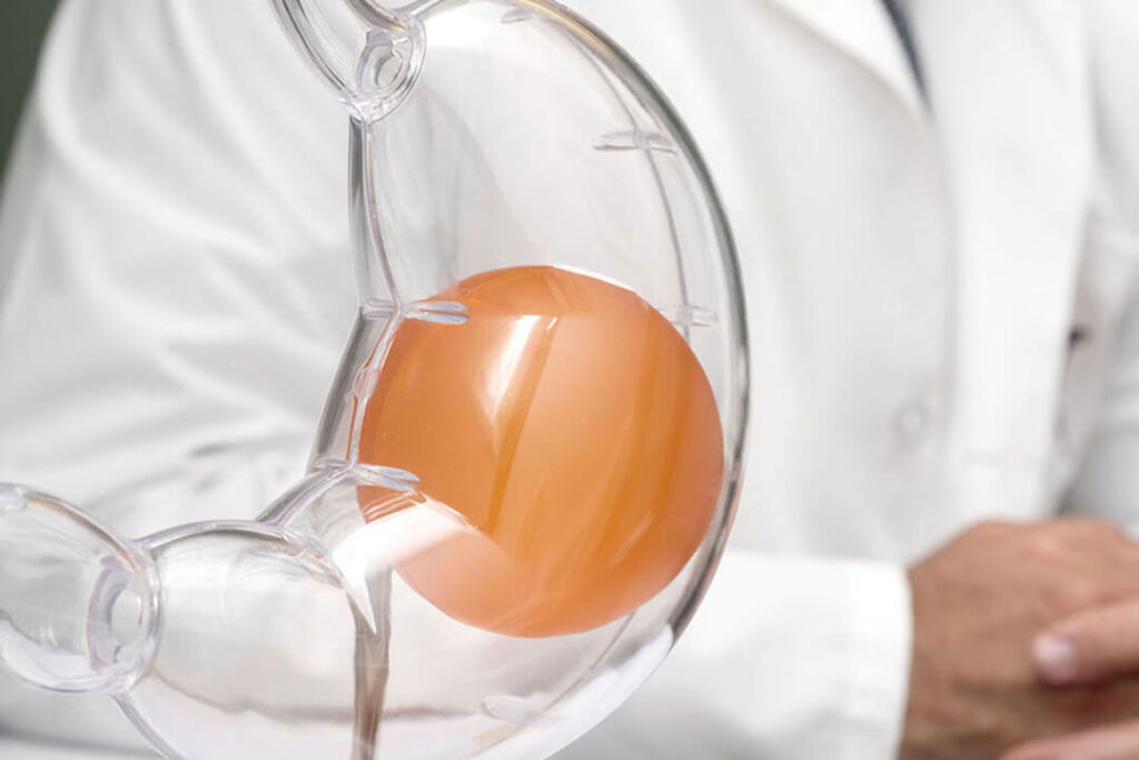 بالون المعدة 