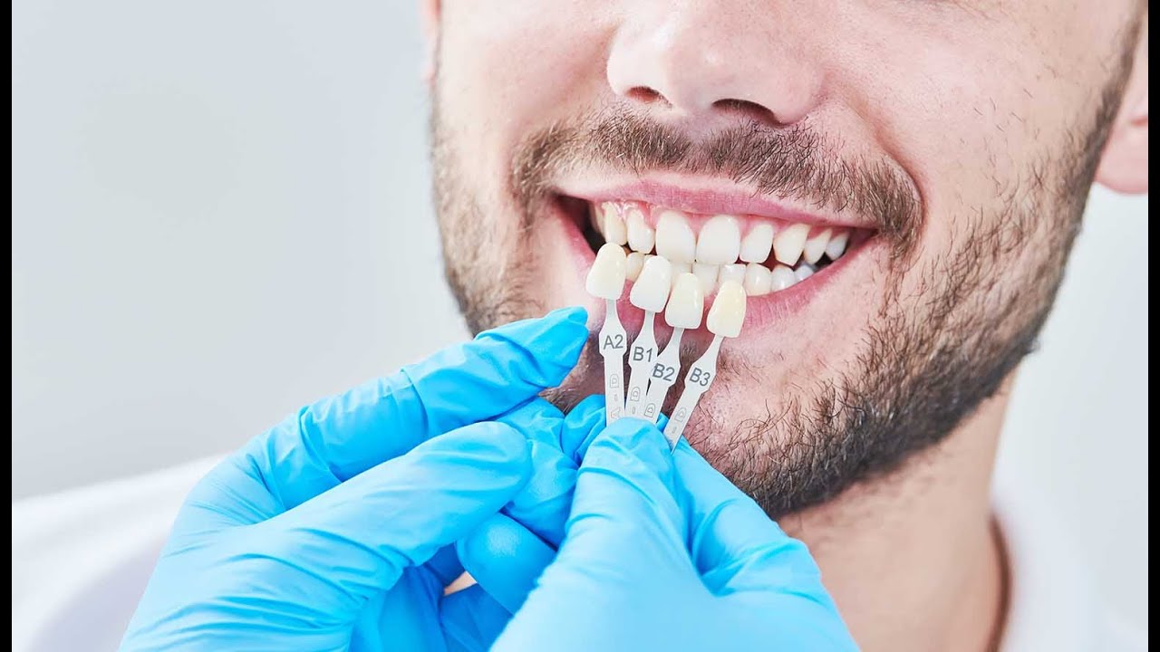 اسعار تلبيس الاسنان