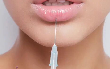 الشفايف الروسية بالفيلر